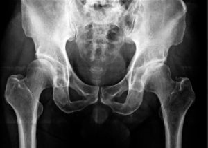 Hip Knee Injuries